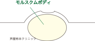 水いぼ4.gif