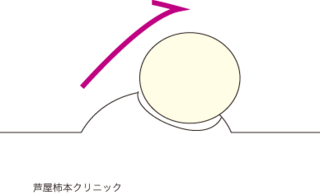 水いぼ5.gif