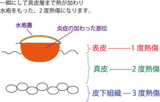 水疱の断面図.jpg
