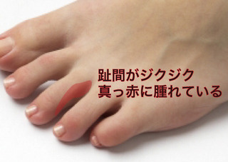 水虫感染.jpg