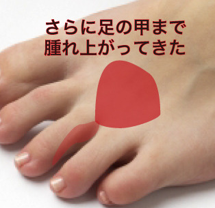 水虫感染2.jpg
