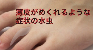 水虫感染3.jpg