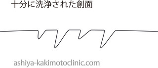洗浄された創面.jpg