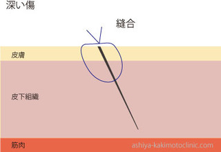 深い傷2.jpg