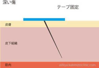 深い傷3.jpg