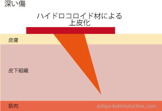 深い傷4.jpg