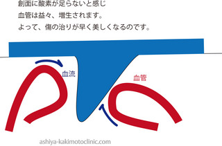 湿潤血管増生.jpg