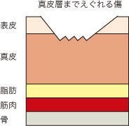 炎症後色素沈着2.jpg