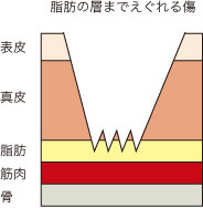 炎症後色素沈着3.jpg