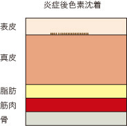 炎症後色素沈着4.jpg