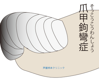 爪甲鉤彎症