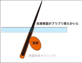 皮脂1.jpg