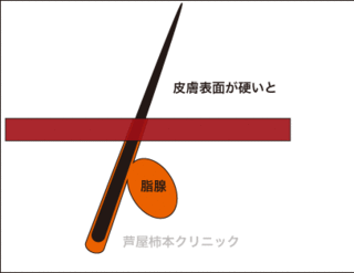 皮脂3.gif