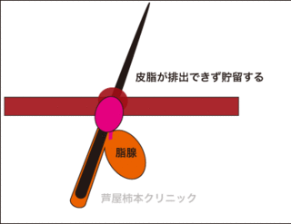 皮脂5.gif