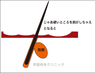 皮脂6.gif