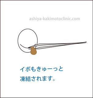 目のイボ5芦屋柿本.jpg