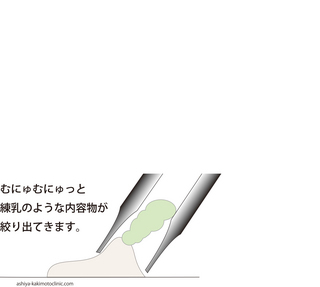 はいりゅうしゅ稗粒腫