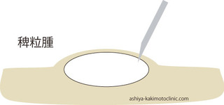 稗粒腫2.jpg