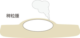 稗粒腫3.jpg