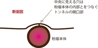 粉瘤2.jpg
