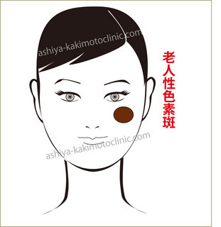 老人性色素斑1.jpg