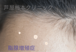 脂腺増殖症.gif