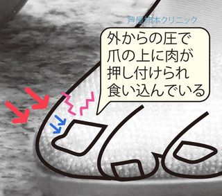 陥入爪柿本クリニック.jpg