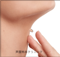 首のイボ