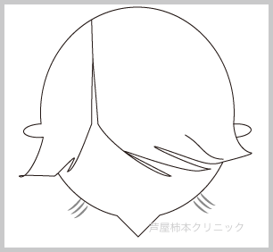 M字脱毛2.gif