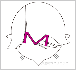 M字脱毛3.gif