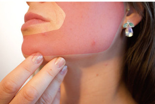 acne2.jpg